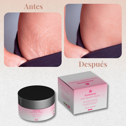 Crema Antiestrias